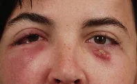 Nódulos eritematovioláceos en párpado inferior derecho y en región malar izquierda, de aspecto quístico y bordes mal definidos, tras cirugía del tercio medio facial. Es la presentación periorbitaria de la infección micobacteriana atípica: sin dolor llamativo, sin fiebre y sin respuesta a los antibióticos habituales. de Castro, Midface Surgery, figura 15.1.